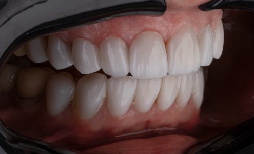 Rehabilitacja stomatologiczna – kiedy warto ją rozważyć?